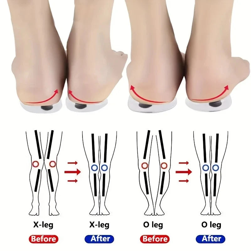 1Pair Orthopedic Insoles for Feet O/X Leg Type Valgus Correction Men
